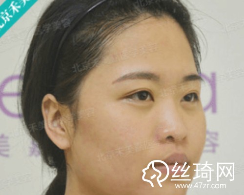 北京禾美嘉醫(yī)療美容自體脂肪填充面部那個醫(yī)生好？