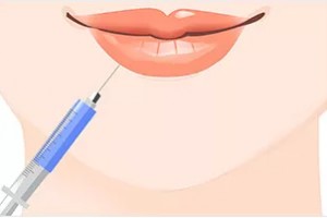 玻尿酸豐唇整形手術(shù)注意事項 注射玻尿酸會腫嗎
