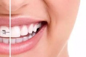 30歲后做牙齒矯正來得及嗎？做正畸會有什么危害？