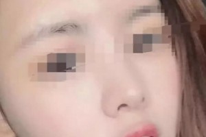 云南瑪麗亞整形美容醫(yī)院做的面部吸脂，原來擁有精致的小臉蛋這么簡單