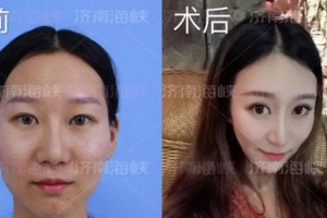 濟南海峽整形自體脂肪填充：取“脂”于你，用“脂”于你!