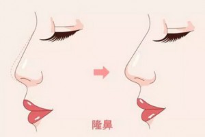 隆鼻前必看，想要隆鼻一定要選擇好方式