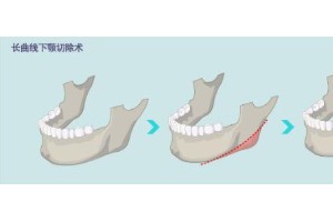 下頷角整形手術(shù)要多少錢？下頜角手術(shù)后護(hù)理注意事項(xiàng)?