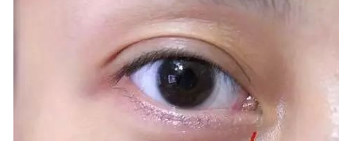 為啥？你做了去眼袋手術后，又復發(fā)了呢？