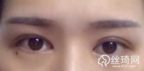 深圳藝星整形醫(yī)生朱輝：為什么你割的雙眼皮會顯得“假”？
