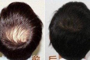 無(wú)錫坤如瑪麗醫(yī)院植發(fā)怎么樣附全新價(jià)格表(價(jià)目表)