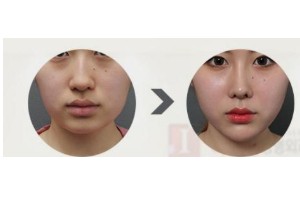 什么是頦部填充術，如何快速消腫