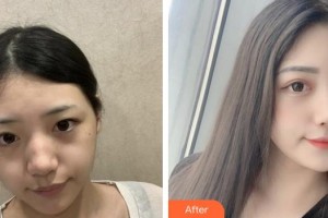 成都漢密爾頓美容醫(yī)院尚瑜整形價格表附激光祛斑案例展示