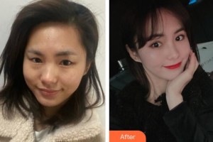 成都美立方（原華博）醫(yī)療美容醫(yī)院張娟整形價格表附眼部綜合案例展示