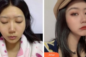 上海仁愛醫(yī)院整形美容科樸宰鉉韓國頭面部整形專家整形價(jià)格表附顴骨內(nèi)推案例展示