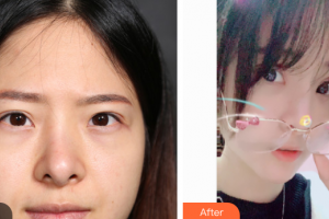 上海華美醫(yī)療美容醫(yī)院葉麗萍整形價(jià)格表附雙眼皮修復(fù)案例展示