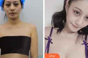 沈陽杏林整形美容醫(yī)院史靈芝整形價格表附假體隆胸，棉花糖假體隆胸案例展示