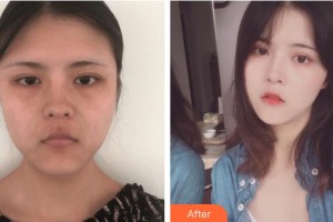 上?？祳W醫(yī)療美容醫(yī)院李倩玉整形價格表附埋線提升案例展示