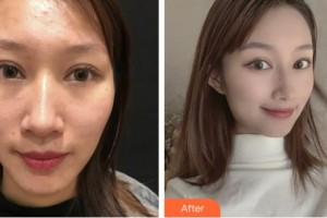 上?？祳W醫(yī)療美容醫(yī)院趙華整形價格表附微針祛痘案例展示