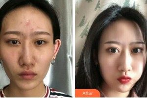上?？祳W醫(yī)療美容醫(yī)院袁智娟整形價格表附激光去紅血絲案例展示