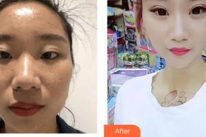武警上?？傟犪t(yī)院整形美容中心曹慧整形價格表附激光祛斑美白肌膚案例展示