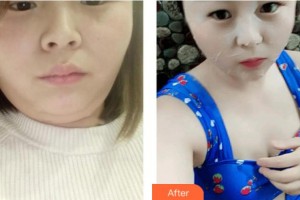 上海美之源整形外科醫(yī)院李月輝整形價格表附光子嫩膚案例展示