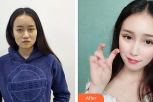 上海比華利整形醫(yī)院李五蘭整形價(jià)格表附韓式切開(kāi)雙眼皮案例展示