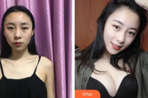 上海愛(ài)美醫(yī)療美容門(mén)診部童富江整形價(jià)格表附假體隆胸案例展示