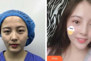 上海茸城女子醫(yī)院整形美容中心金志洙整形價(jià)格表附雙眼皮眼部手術(shù)案例展示