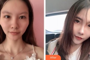 上海瑪麗醫(yī)院整形美容中心楊月秀整形價(jià)格表附顴骨顴弓整形案例展示