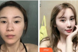 上?，旣愥t(yī)院整形美容中心謝宏德整形價(jià)格表附切開(kāi)雙眼皮案例展示