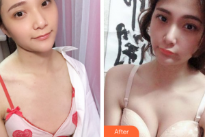 廣州利美康粵美醫(yī)療美容門(mén)診部范建輝整形價(jià)格表附自體脂肪隆胸案例展示