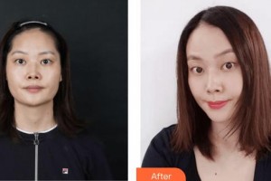 上?？祳W醫(yī)療美容醫(yī)院胡康容整形價格表附光子嫩膚案例展示