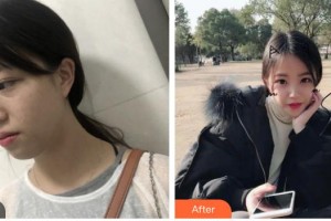 上海復(fù)麗醫(yī)療美容門診部莊賀婷整形價格表附超激光美膚激光案例展示