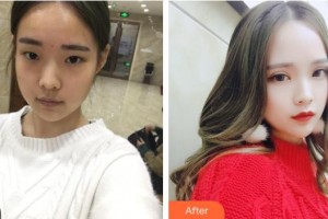 上海楊思醫(yī)院醫(yī)學美容科巴友良整形價格表附眼部手術(shù)案例展示