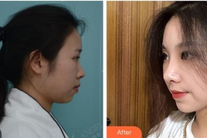 上海宸妃醫(yī)學美容醫(yī)院王雷整形價格表附打造精致自然翹鼻案例展示