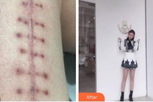 上海港華醫(yī)院浦東分院（悅?cè)葆t(yī)療美容診所）王美華整形價格表附微創(chuàng)疤痕修復案例展示