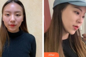 上海首爾麗格醫(yī)療美容醫(yī)院高益秀整形價格表附隆鼻案例展示