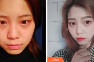 上海WA臻景醫(yī)療美容門診部李載成整形價格表附假體隆下頜案例展示