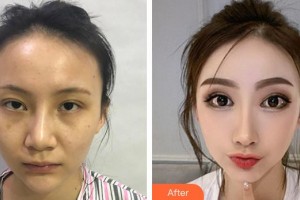 上海伊萊美醫(yī)療美容醫(yī)院李湘源整形價格表附創(chuàng)可貼面部吸脂瘦臉塑輪廓案例展示