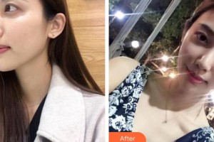 上海鵬愛醫(yī)療美容門診部鄭仕平整形價(jià)格表附假體隆鼻案例展示