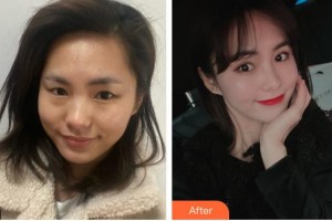 貴陽醫(yī)學(xué)院附屬醫(yī)院燒傷整形外科孔豫蘇整形價(jià)格表附眼部綜合案例展示