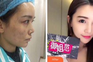 珠海愛思特醫(yī)療美容醫(yī)院李德新整形價(jià)格表附鼻部整形案例展示