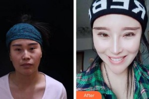 合肥劉大夫美容整形醫(yī)院劉向陽整形價(jià)格表附鼻部綜合案例展示