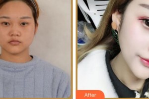 上海諾詩雅醫(yī)療美容醫(yī)院楊民鋒整形價(jià)格表附鼻部綜合案例展示