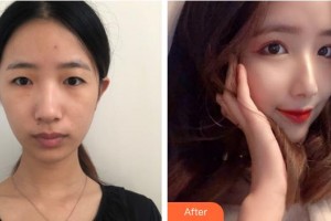 上海和平眼科醫(yī)院湯萌整形價格表附眼部綜合案例展示