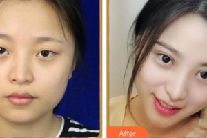 上海容妍醫(yī)療美容門診部柴云整形價格表附鼻部手術案例展示