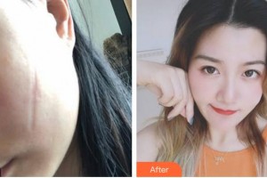 上海明珠醫(yī)院整形美容中心崔春雷整形價格表附手術祛疤案例展示