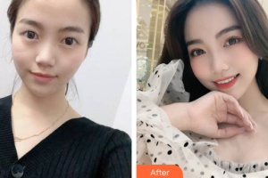上海德媛醫(yī)療美容門診部閔香花整形價格表附埋線雙眼皮案例展示