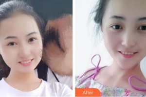 上海華美醫(yī)療美容醫(yī)院黃嵩整形價格表附半隱形單晶案例展示