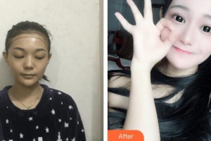 上海伊萊美醫(yī)療美容醫(yī)院李宇飛整形價格表附頭發(fā)種植案例展示