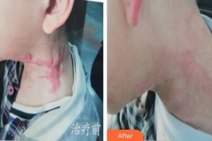 上海瑞金醫(yī)院舟山分院燒傷整形美容科黃曉琴整形價格表附燙傷疤痕修復案例展示
