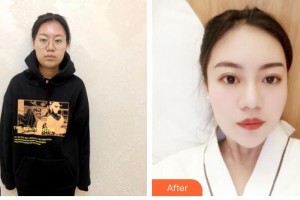 上海愛爾麗醫(yī)療美容門診部吳瑞星整形價格表附創(chuàng)可貼面部吸脂瘦臉案例展示