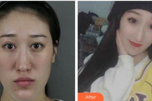 上海愛爾麗醫(yī)療美容門診部羅國銓整形價格表附多方面部吸脂瘦臉案例展示