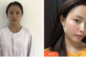 上海臻妮醫(yī)療美容門診部湯玉祥，男，主治醫(yī)生，畢業(yè)整形價格表附創(chuàng)可貼面部吸脂瘦臉案例展示